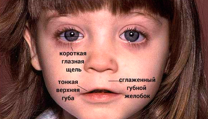 Алкогольный синдром плода