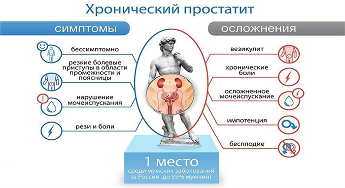 Хронический простатит