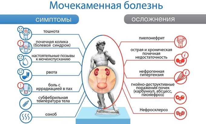 При мочекаменной болезни в различных отделах мочевыводящей системы формируются камни. В большинстве случаев этот процесс происходит в почках и мочевом пузыре