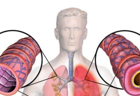 Бронхиальная пневмония – это воспалительный процесс, при котором нарушается дренаж нижних отделов бронхов и формируются очаговые прикорневые очаги в легких