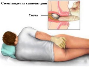 Схема введения суппозитория