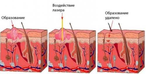 Схема лазерного удаления новообразования