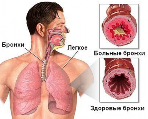 При бронхите в воздухоносных путях развивается воспаление и скапливается слизь
