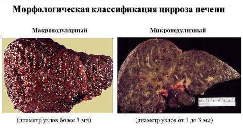 Морфологическая классификация цирроза