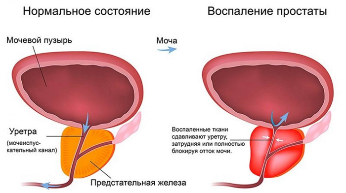 Воспаление простаты