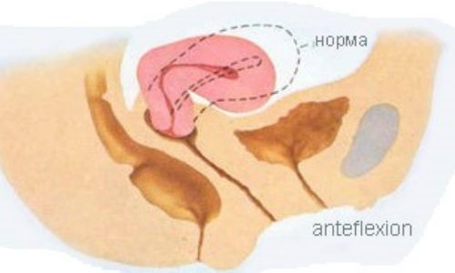 Anteflexio положение матки