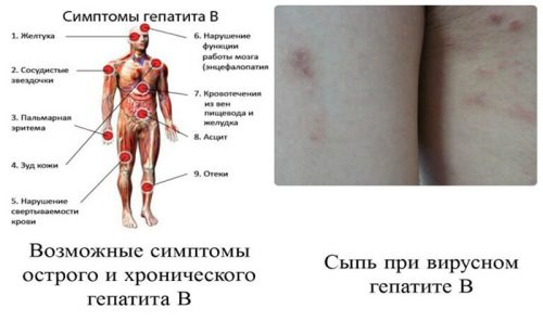 Симптомы гепатита В