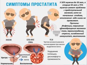 Симптомы простатита
