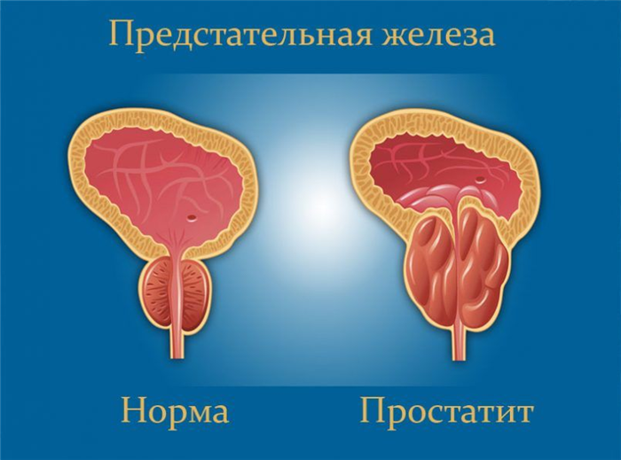Простатит
