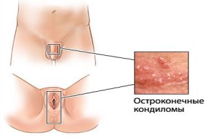 Остроконечные кондиломы у мужчин и женщин