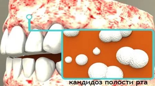 Кандидоз полости рта
