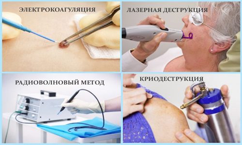 Способы удаления папиллом