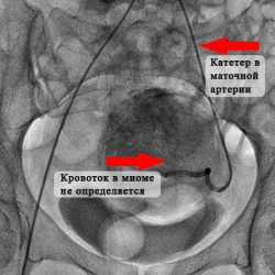 Катетер в маточной артерии