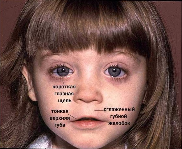 Симптомы фетального алкогольного синдрома