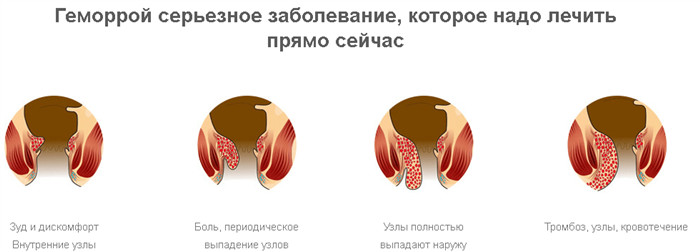 Чем опасен геморрой