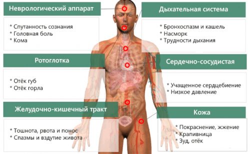 Симптомы анафилактического шока