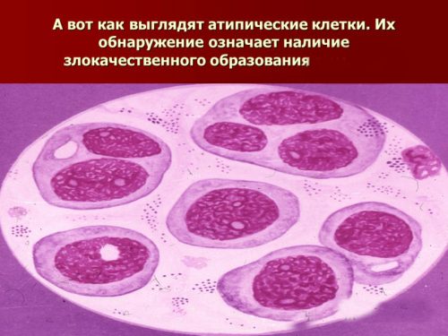 Атипические клетки