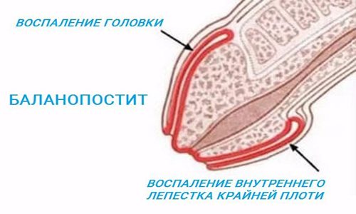 Схема баланопостита