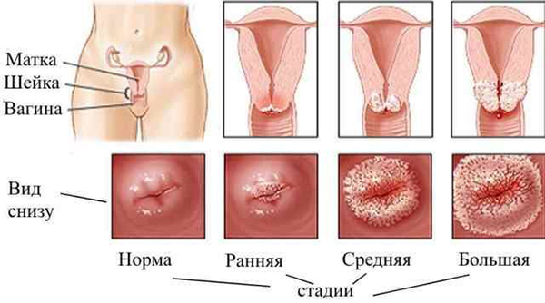 Стадии эрозии