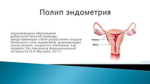 Полип эндометрия