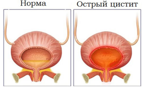 При остром цистите употребление лекарственных средств на основе шиповника нормализует мочеиспускание и ускоряет выздоровление