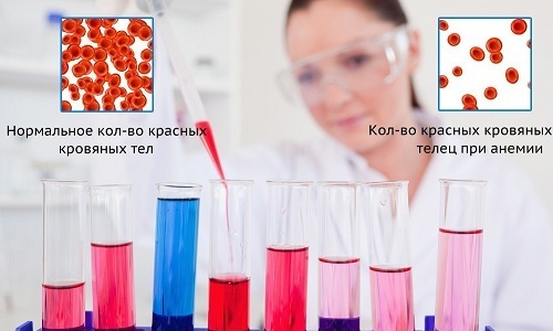 Из-за постоянной потери крови, отводящейся с мочой, может развиться анемия