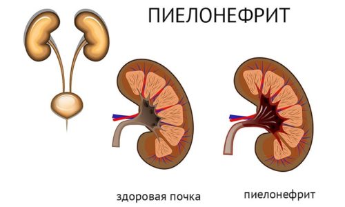 Длительное течение заболевания у мужчин может способствовать развитию пиелонефрита (воспаления почек)