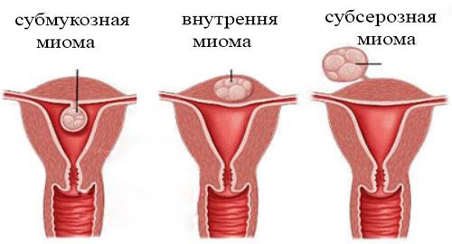 Виды миом