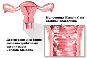 Влагалищный кандидоз