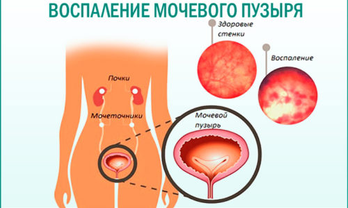 Воспаление мочевого пузыря требует применения антибактериальных препаратов, при этом продолжительность лечения может составлять от 1 до 4-6 недель