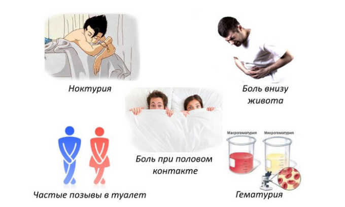 Симптомы цистита