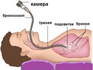 Проведение бронхоскопии