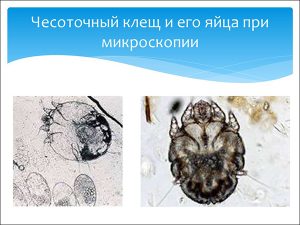 Чесоточный клещ и его яйца