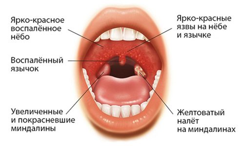 Признаки заболевания