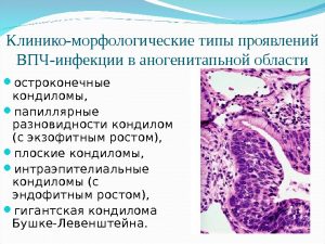 Типы проявлений ВПЧ-инфекции