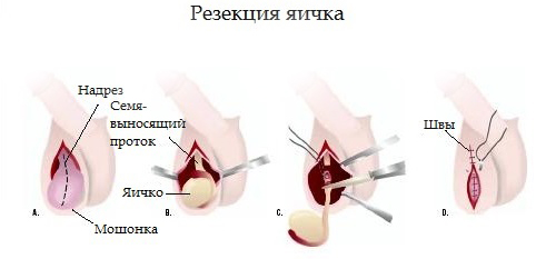 Резекция яичка