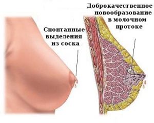 Внутрипротоковая папиллома