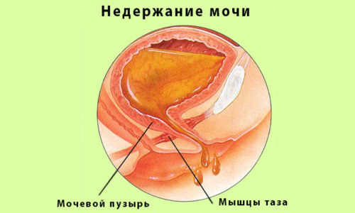 Лишь иногда как осложнение наблюдается недержание мочи