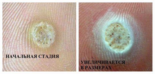 Папиллома на подошве