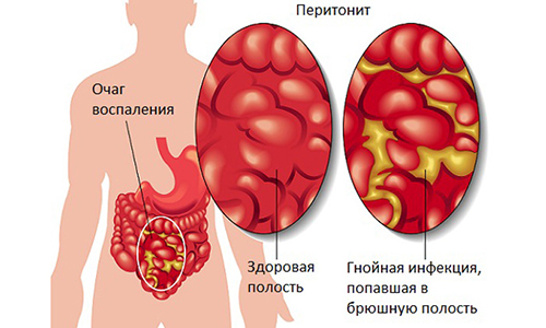У ребенка причиной изменения цвета мочи становится гнойный процесс в организме