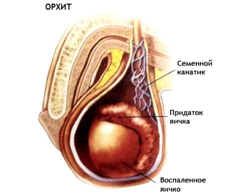 Орхит или воспаление тестикул