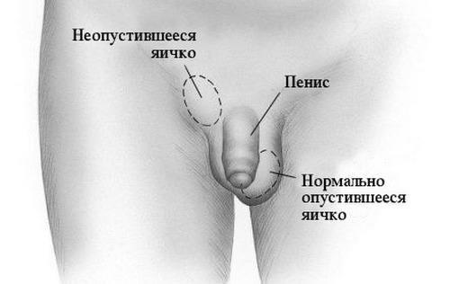 Крипторхизм
