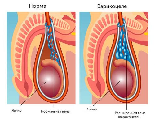 Варикоцеле