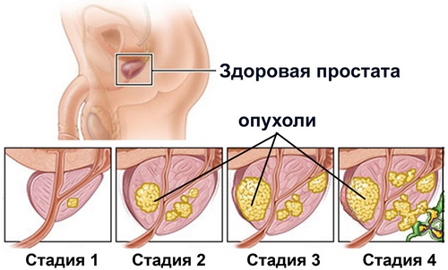 Стадии аденомы простаты