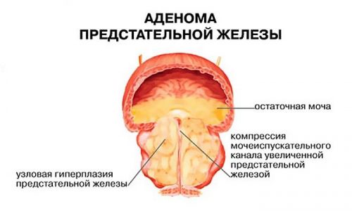 Аденома простаты