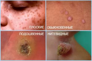 Распространенные виды папиллом
