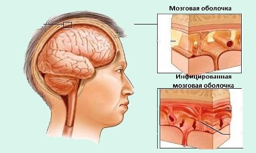 Гнойный менингит