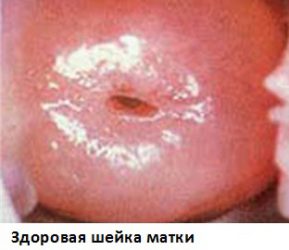 Здоровая шейка матки