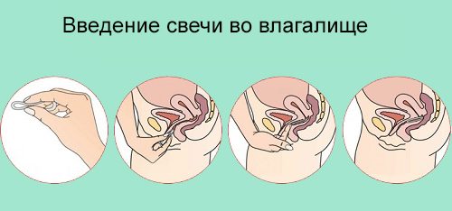 Введение свечи во влагалище