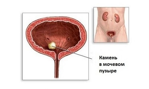 При мочекаменной болезни терапию начинают с растворения камней в почках и мочевом пузыре